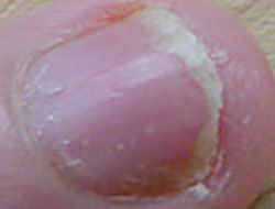 Finger Nail Pitting Caused By Psoriasis