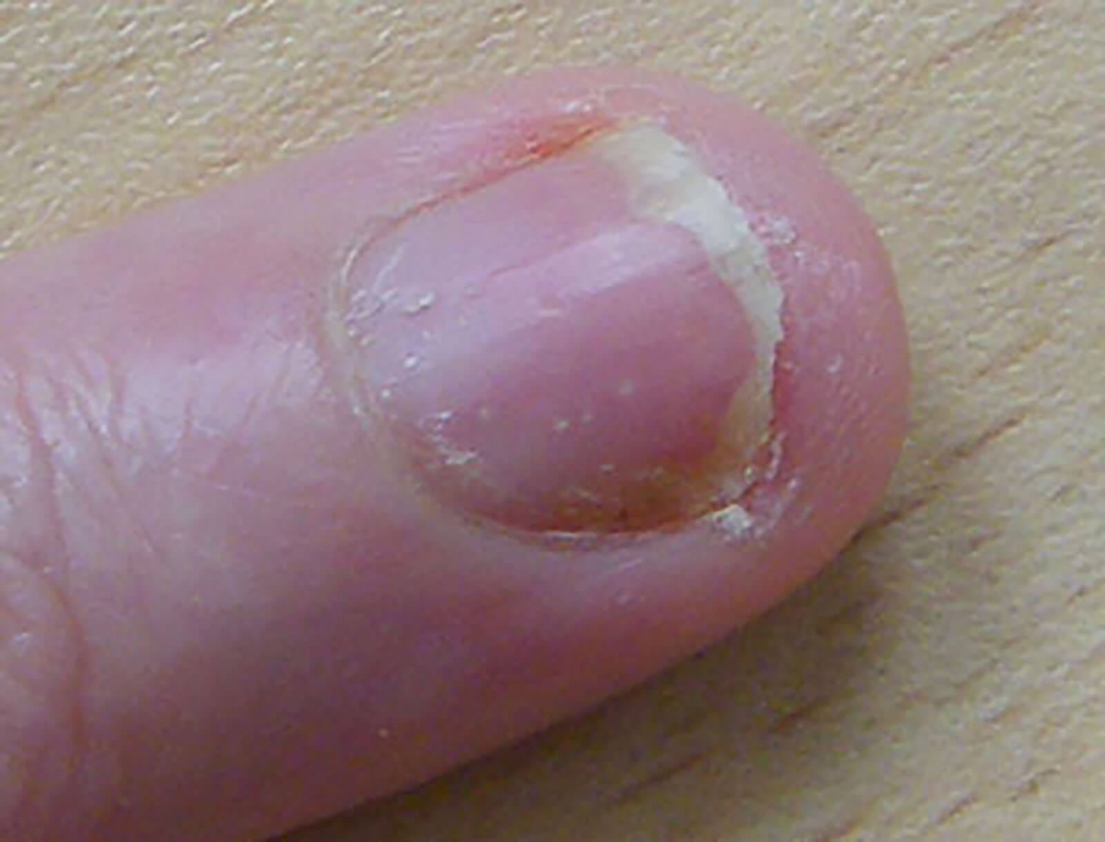 Optimal management of nail disease in patients with psoriasis. - Abstract -  Europe PMC