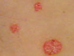 Psoriasis clusters on the body