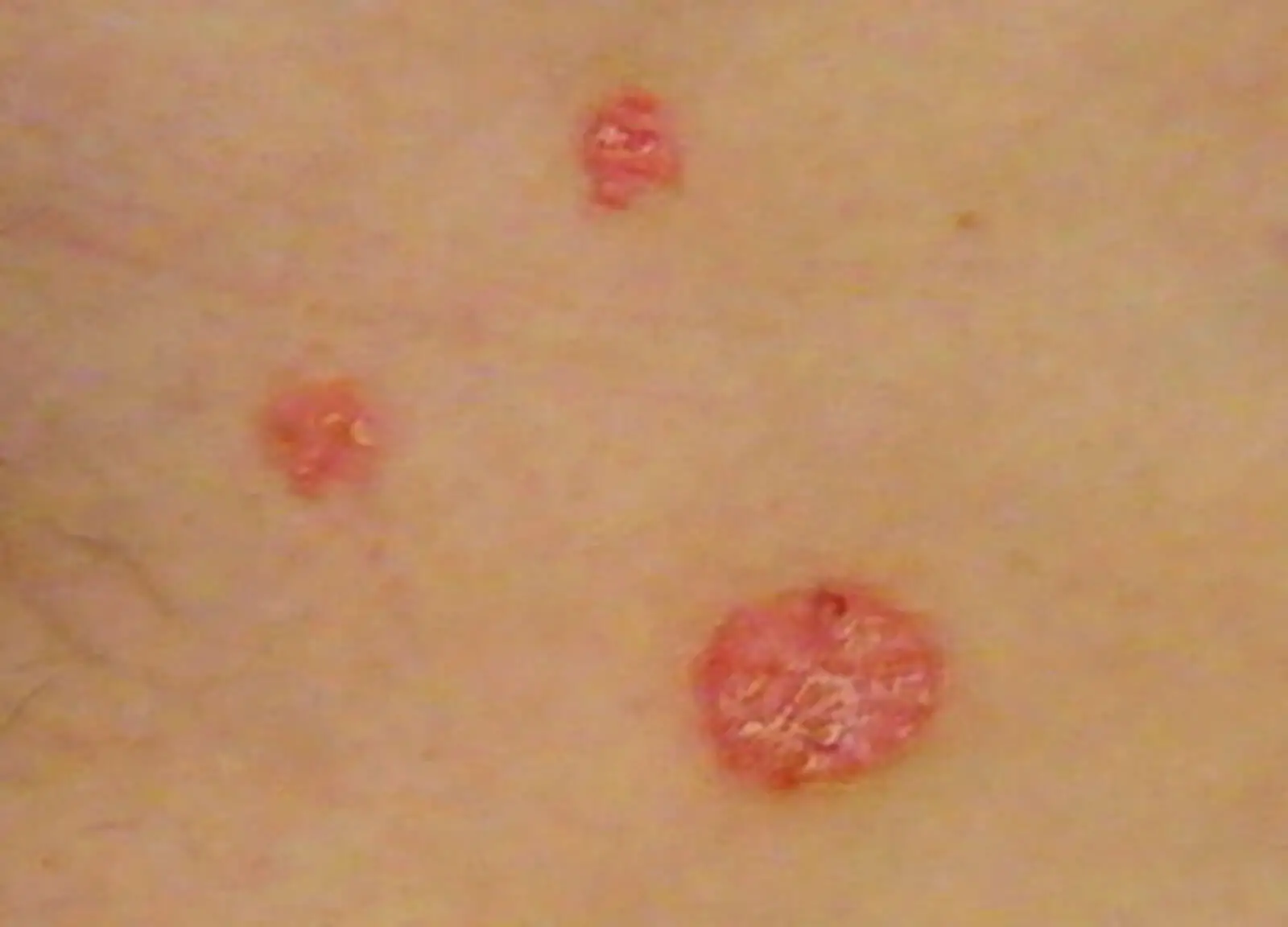 Psoriasis On The Skin Of The Lower Abdomen