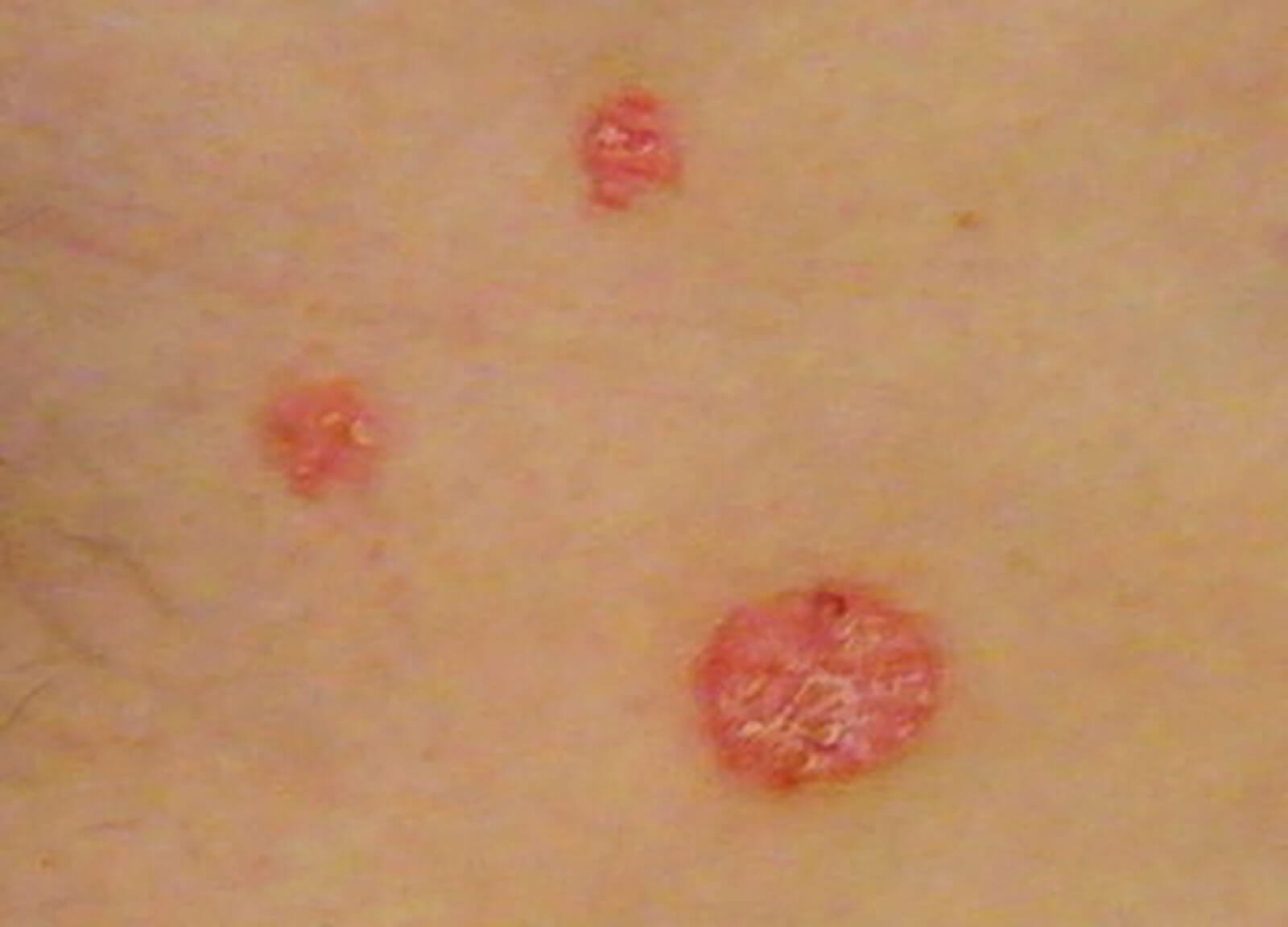 Psoriasis On The Skin Of The Lower Abdomen