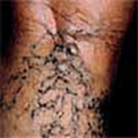 Spider Veins Spider Veins